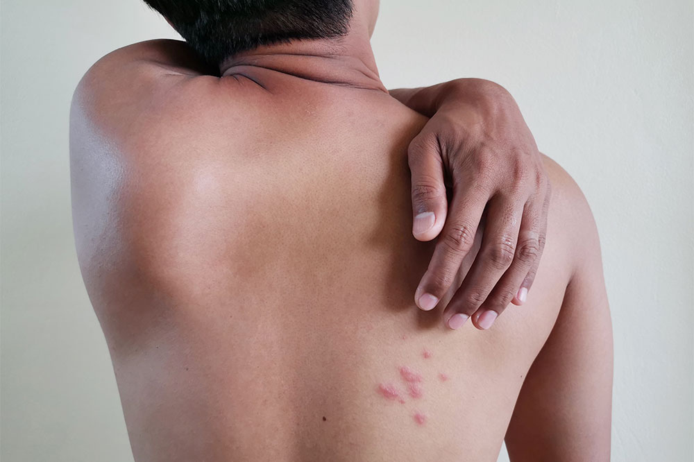 Shingles – Treatment options and preventive measures